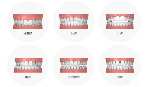 上下牙咬合不正常