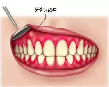 牙龈红肿.jpg