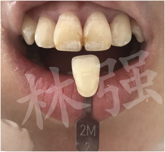 牙齿美容贴面修复案例