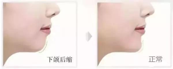 儿童牙齿矫正什么年龄合适？12岁前必须处理的12种牙颌畸形