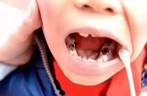 儿童牙齿矫正什么年龄合适？12岁前必须处理的12种牙颌畸形