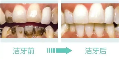 牙生病了一拖再拖？越拖你花的钱就越多