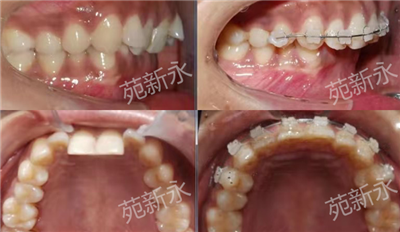 　【昌平牙齿矫正】矫正究竟为了什么?颜值?