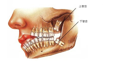 【昌平拔智齿】什么样的智齿必须拔？什么样的智齿不用拔？