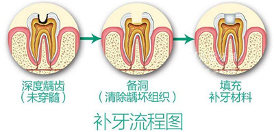 【昌平补牙】昌平补牙多少钱？同样是补牙为啥价格差异这么大？