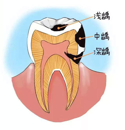 【昌平补牙】说好的补牙为啥变成“钻牙”？补牙材料怎么选？
