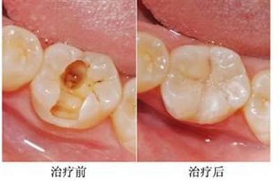 【昌平补牙】说好的补牙为啥变成“钻牙”？补牙材料怎么选？