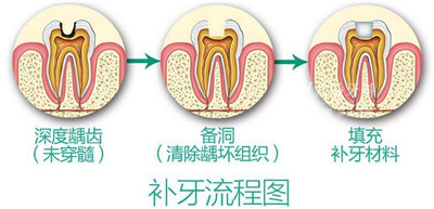 【昌平补牙】说好的补牙为啥变成“钻牙”？补牙材料怎么选？