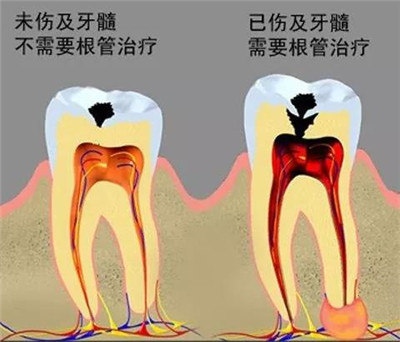 【昌平补牙】牙齿烂了一半，能直接补牙吗？