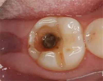 【昌平补牙】牙齿烂了一半，能直接补牙吗？