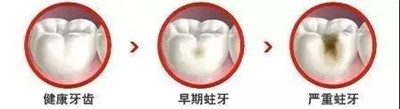 【昌平补牙】牙齿烂了一半，能直接补牙吗？