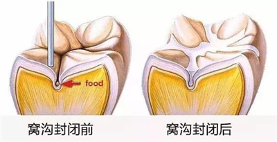 10万元的牙病，其实花30元就能解决，怎么解决？看这里！