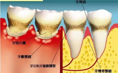 【昌平洗牙】从不洗牙的人牙齿掉的快,仔细看完就明白了