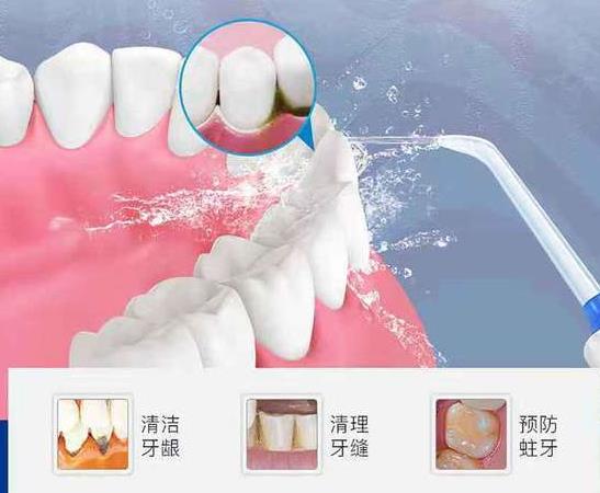 洗牙一次多少钱 为什么说洗牙是投资回报最高的一件事