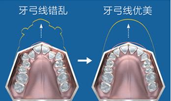 MRC儿童矫正器难受吗 MRC矫正会有副作用吗